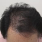 AGA（男性若年性脱毛症治療）